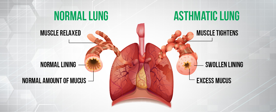 A Human Lung Showing on Its Left Side the Characteristics of a Normal Lung, and on the Left, the Characteristics of an Asthmatic Lung